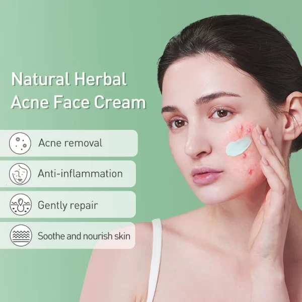 JOYPRETTY Herbal Acne Cream - Image 2